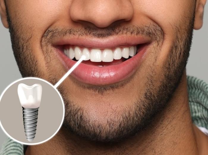 The Comprehensive Guide to Dental Implants: Why Hall Family Dentistry is Your Best Choice