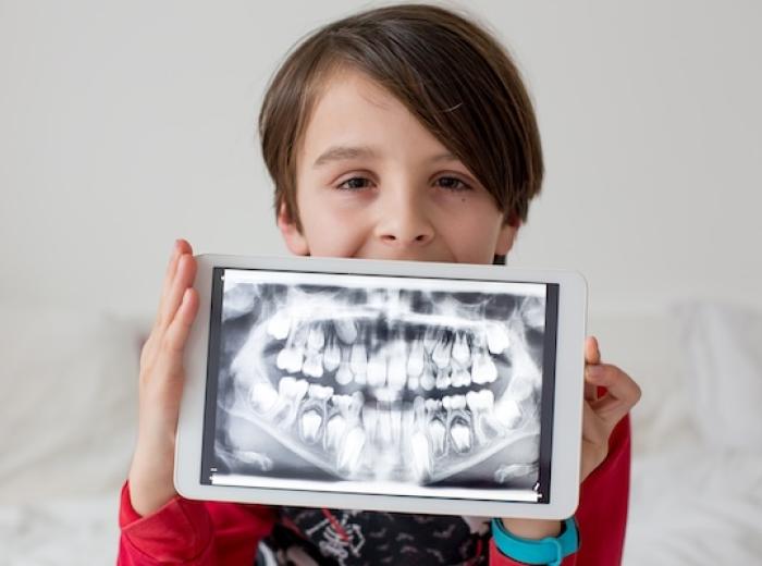 What Are the Different Types of Dental X-Rays? – Why Choose Us For This