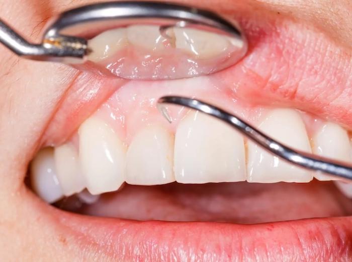The Stages of Gum Disease and How to Prevent It