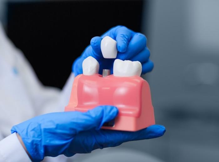 Essential Insights on Dental Implants: Your Trusted Source in Southeast Indianapolis