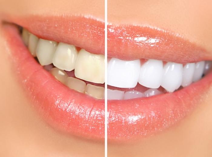 Look 10 Years Younger with Teeth Whitening | Hall Family Dentistry