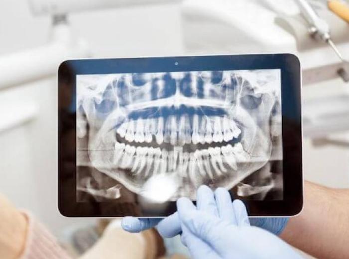 What Are the Different Types of Dental X-Rays?