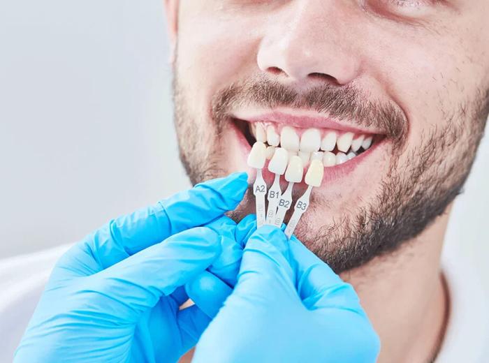 What are Dental Veneers? | Dentist Southeast Indianapolis